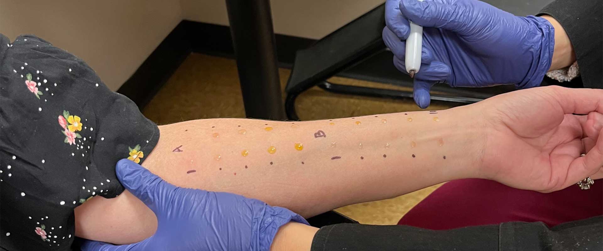 Allergy Testing at Martin's Wellness