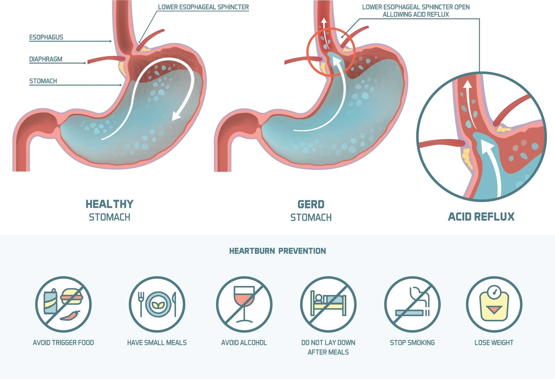 What Can Cause Sudden Acid Reflux