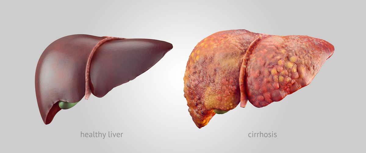 Healthy Liver vs Liver With Cirrhosis